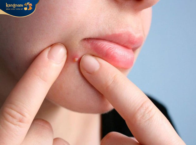 Không dùng tay nặn mụn ở cằm hoặc xung quanh miệng