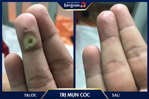 Kết quả hết dứt điểm mụn cóc sau liệu trình điều trị chuyên sâu với Laser Fractional CO2 mụn cơm có bị lây không