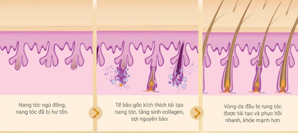 nguyên nhân gây rụng tóc ở nam giới