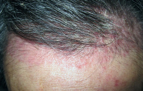 nguyên nhân rụng tóc ở nam