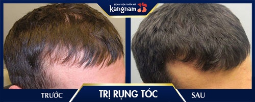 chữa bệnh rụng tóc từng mảng tại kangnam bệnh rụng tóc từng mảng