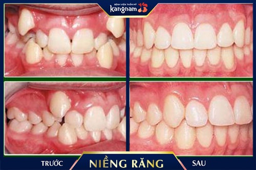 niềng răng khểnh giá bao nhiêu