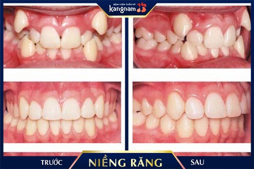 niềng răng khểnh như thế nào niềng răng khểnh như thế nào