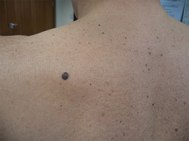 Vị trí, kích thước và màu sắc nốt ruồi sẽ thể hiện ý nghĩa khác nhau