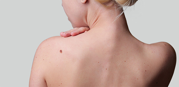 Nốt ruồi trên vai trái phụ nữ