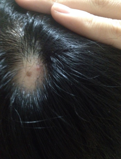 Nốt ruồi ở đỉnh đầu báo hiệu bạn có tướng số làm lãnh đạo cấp cao nốt ruồi ở đỉnh đầu