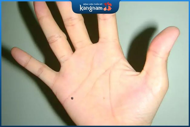 Nốt ruồi tại gò hỏa tinh lòng bàn tay