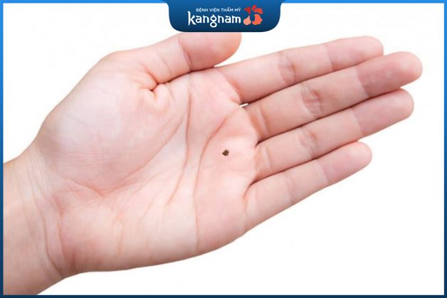 Nốt ruồi ở lòng bàn tay hầu hết đều là điềm may mắn cho chủ sở hữu