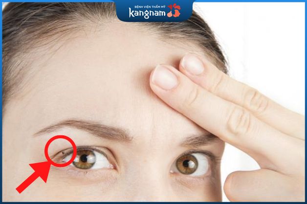 Nốt ruồi trên mí mắt trái