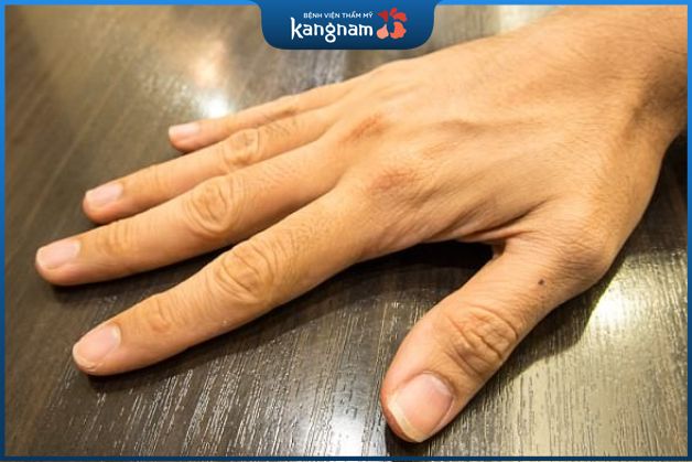 Đàn ông có mụn ruồi ở ngón cái thường khá nghĩa hiệp và nhiệt tình.