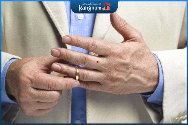 Nốt ruồi son ở ngón giữa đàn ông là đặc điểm quý tướng mà ai cũng muốn sở hữu