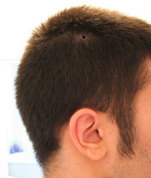 Nếu ảnh hưởng tới tính thẩm mỹ, bạn hoàn toàn có thể tẩy bỏ nốt ruồi trên đầu mà không lo ảnh hưởng tới số mệnh của mình nốt ruồi trên đầu đàn ông