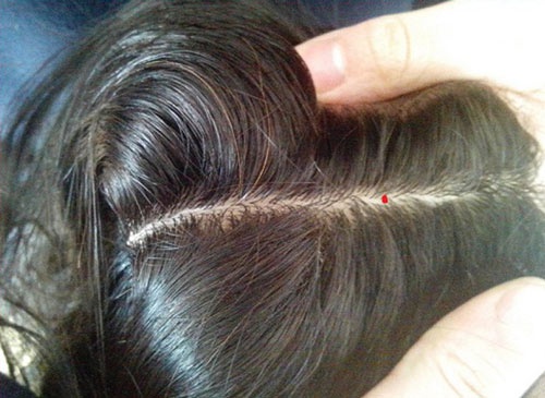 Nốt ruồi ẩn trong chân tóc được xem là rất may mắn, mang đến đại cát đại lợi cho gia chủ nốt ruồi trên đầu trong tóc