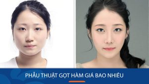 Phẫu thuật gọt hàm giá bao nhiêu