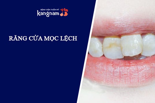 Răng mọc lệch hình chữ V, mọc nghiêng hẳn 1 bên hoặc chĩa ra 2 bên răng cửa dưới mọc lệch vào trong