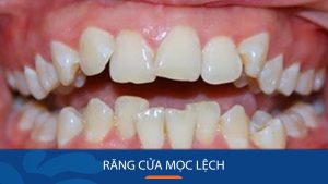 Nguyên nhân răng cửa mọc lệch và cách điều trị hiệu quả 90%