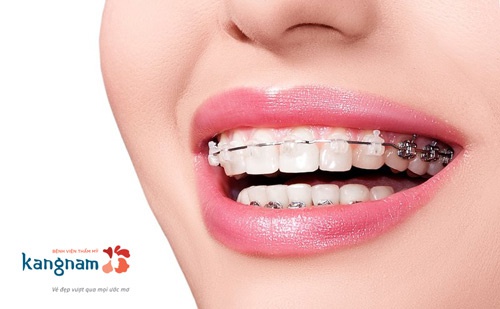 Niềng răng giúp cải thiện toàn bộ cấu trúc ổ răng mọc lệch nhiều, khắc phục hàm hô/móm răng cửa mọc lệch phải làm sao