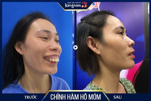 Phẫu thuật hàm hô móm kết hợp chỉnh nha là phương pháp tối ưu đối với trường hợp khách hàng bị vẩu cấp độ nặng bọc răng sứ hay phẫu thuật hàm hô móm