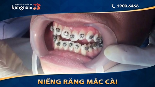 Niềng răng đòi hỏi người dùng phải kiên trì trong 1 khoảng thời gian từ 1 - 2 năm nên bọc sứ hay niềng răng hô