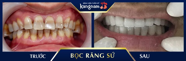 chân răng sứ bị hôi thì phải làm sao? chân răng sứ bị hôi