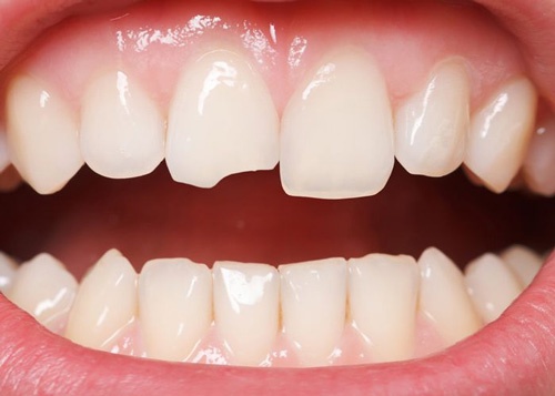 Trường hợp răng bị mẻ, khuyết thiếu nên sử dụng phương pháp bọc răng Ceramill răng sứ ceramill là gì