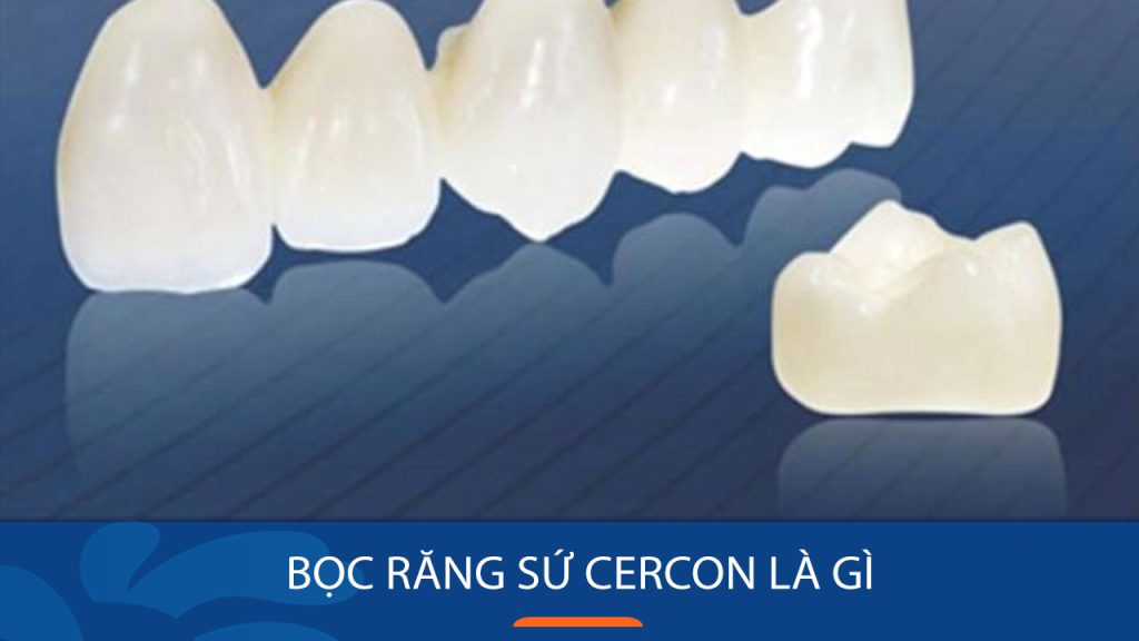 Bọc răng sứ Cercon là gì? Có tốt không? Giá bao nhiêu tiền?