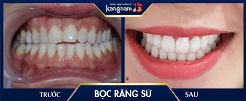 bọc răng sứ có vĩnh viễn không 