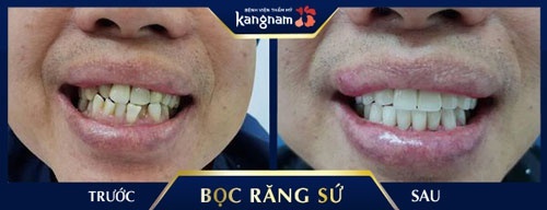 Hiệu quả thẩm mỹ toàn diện, cải thiện hàm răng ố vàng, khấp khểnh răng sứ venus đức