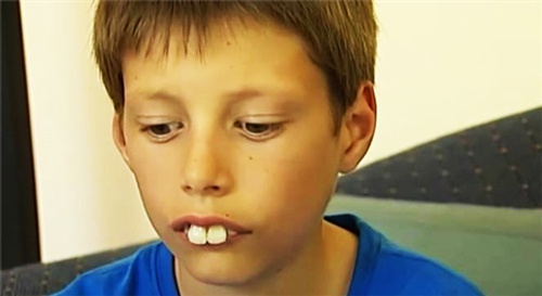 Răng thỏ hô, quá to không được đánh giá cao về thẩm mỹ mẫu răng thỏ