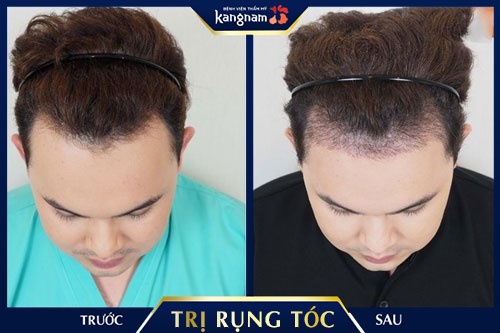 bị rụng tóc nhiều ở tuổi dậy thì