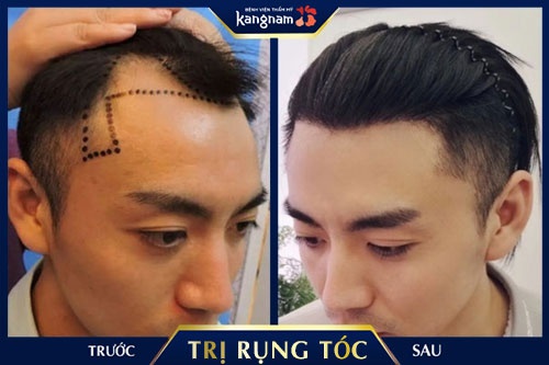 rụng tóc sau sinh nên uống gì