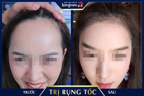 guyên nhân rụng tóc nhiều ở tuổi dậy thì