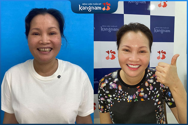 Răng xỉn màu lệch lạc đã được thay bằng bộ răng sứ trắng sáng