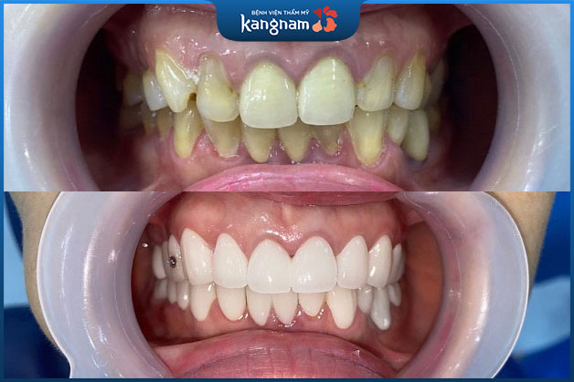 Kĩ thuật mài răng bọc sứ giúp chỉnh nha lệch đường giữa nhanh chóng