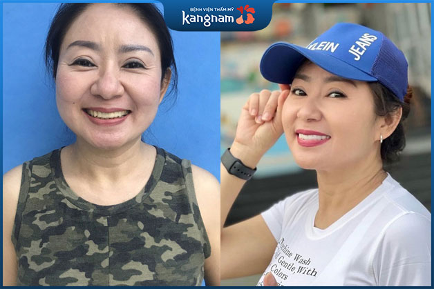 Anh Hải (Bắc Giang) sở hữu hàm răng trắng sáng đều màu sau khi thực hiện bọc răng sứ tại Kangnam