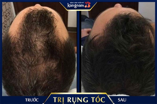 thực phẩm tốt cho tóc rụng thực phẩm tốt cho tóc rụng