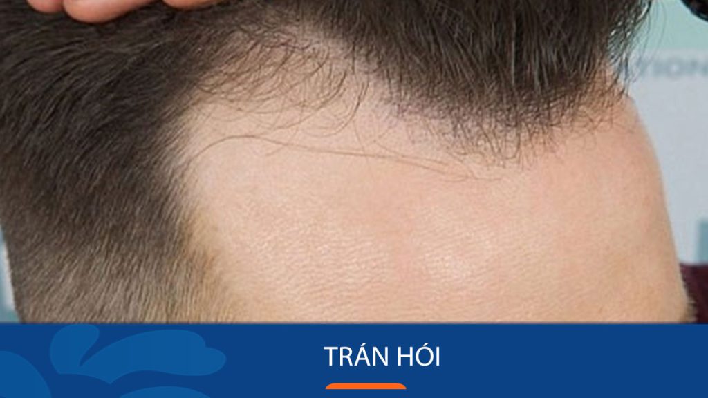 Trán hói: Dấu hiệu, nguyên nhân và cách điều trị tận gốc