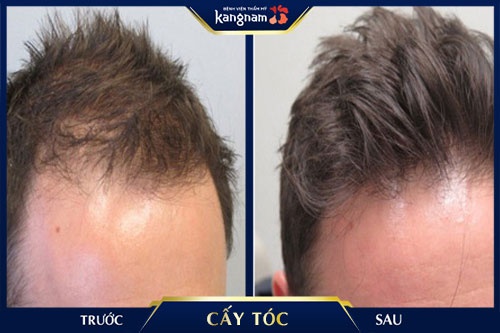 trán hói nam trán hói nam