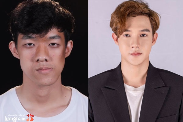 Nhìn trực diện: Vùng hàm cân đối, khuôn mặt hài hòa, sai lệch khớp cắn đã được khắc phục