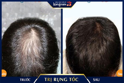 trị rụng tóc ở nam giới