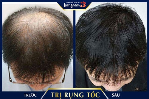 trị rụng tóc ở tuổi dậy thì trị rụng tóc ở tuổi dậy thì