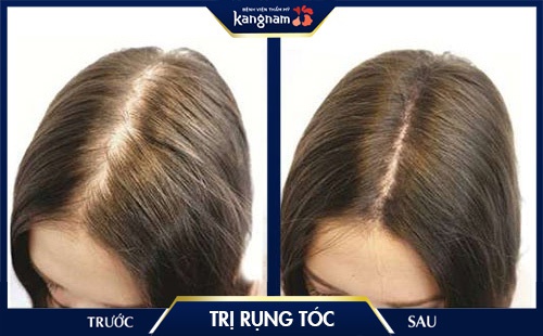 Tóc mọc lên đáng kể sau khi kích thích bằng tế bào tự thân PRP cách trị rụng tóc