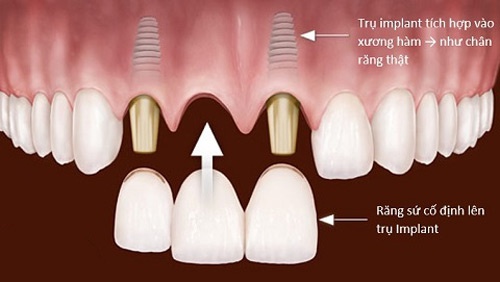 Làm răng thỏ đẹp bằng cấy Implant răng thỏ dễ thương