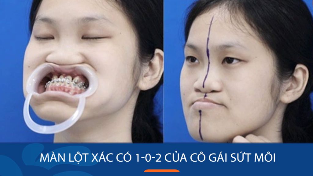 Màn lột xác có 1-0-2 của cô gái sứt môi hở hàm ếch