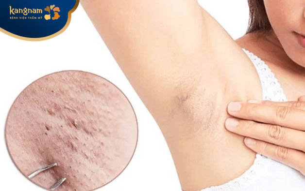 Bệnh lý viêm lỗ chân lông ở nách