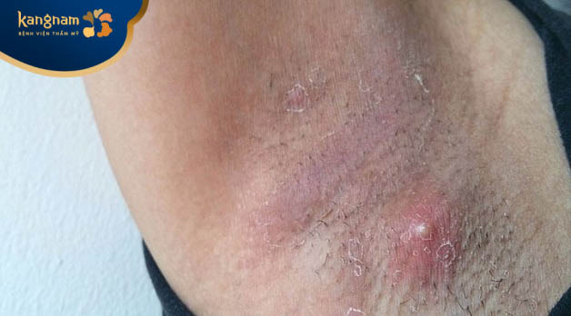 Mụn trứng cá, mụn bọc, u nhọt ở nách