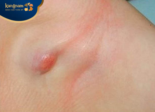 Mụn ở nách có nguy hiểm không?