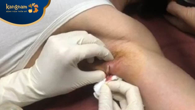 Ổ nhọt to ở nách cần đến bác sĩ để hút hết mủ viêm ra ngoài