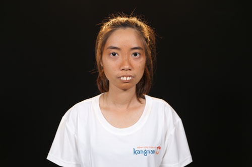 ảnh trước phẫu thuật nguyễn thị huê ảnh trước phẫu thuật nguyễn thị huê