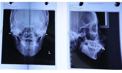 khám sức khỏe chụp xương nguyễn thị huê